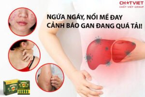 ByeAlco - mề đai mẫn ngứa trị được láng