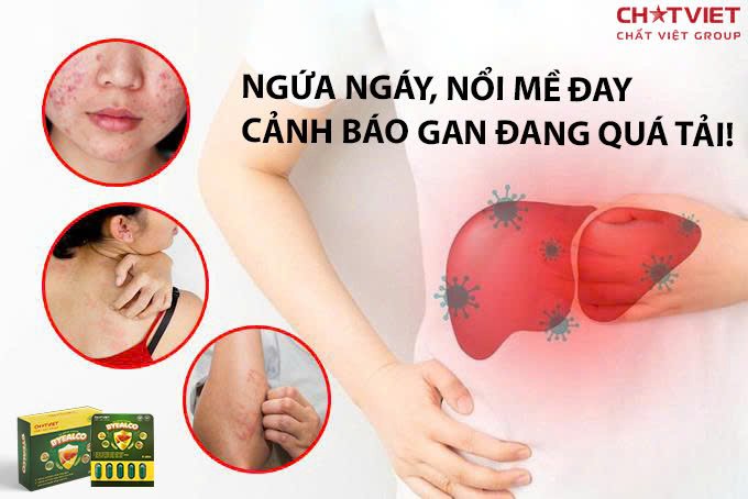 ByeAlco - mề đai mẫn ngứa trị được láng